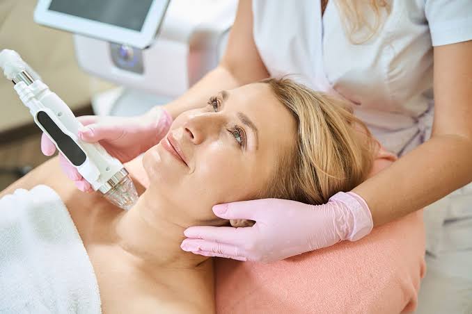 RF Microneedling